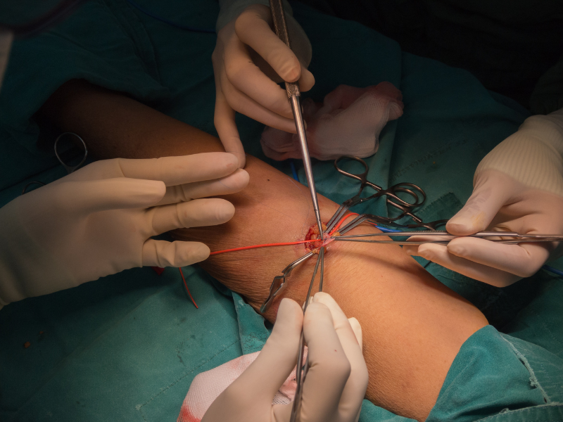 Performing AV fistula dialysis access procedure